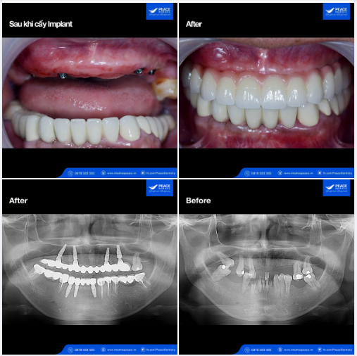 Khôi phục trọn vẹn chức năng ăn nhai và thẩm mỹ cho khách hàng lớn tuổi