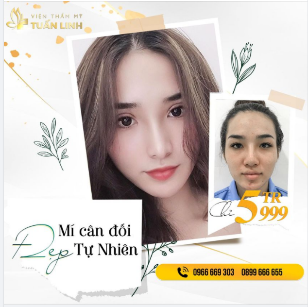 KHÔNG CHỈ NÂNG MŨI ĐẸP - TUẤN LINH CÒN CẮT MÍ CỰC XINH NỮA BẠN NHÉ.