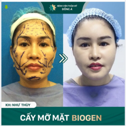 Không có phụ nữ xấu, chỉ có phụ nữ chưa đi cấy mỡ mặt mà thôi...