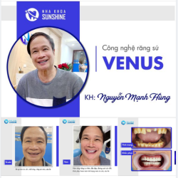 KHÔNG CÒN CHÚT KHUYẾT ĐIỂM TRÊN RĂNG CHỈ SAU 2 LẦN HẸN