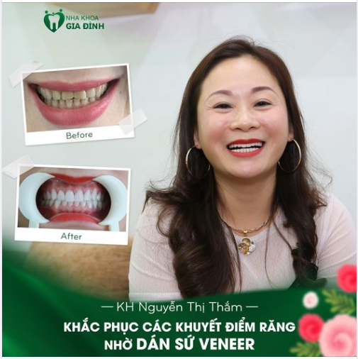 KHÔNG CÒN RĂNG XẤU, ĐẸP NGAY CHỈ SAU 2 NGÀY