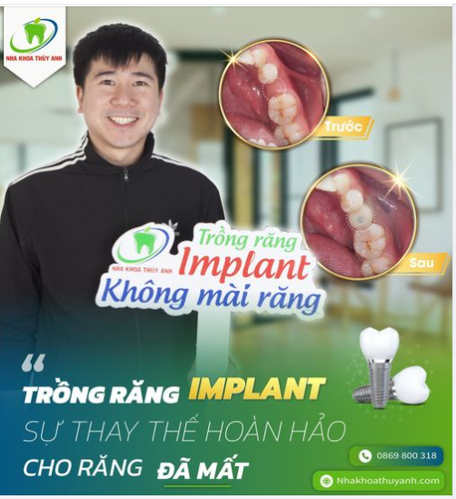 KHÔNG LO MẤT RĂNG VÌ ĐÃ CÓ IMPLANT THAY THẾ