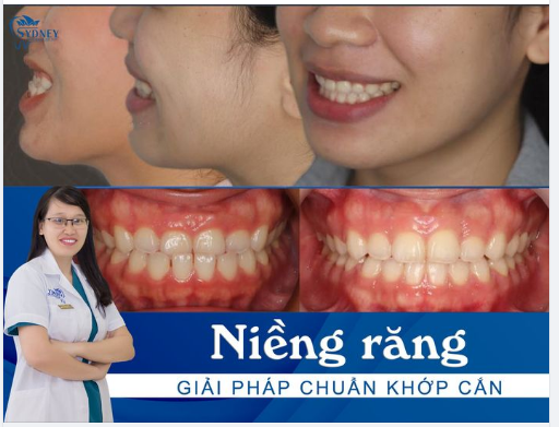 KHỚP CẮN CHUẨN LÀ GÌ - SAI LỆCH KHỚP CẮN CẦN LÀM GÌ 