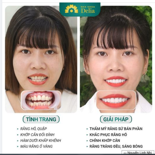 Khớp cắn đối đỉnh & răng hô có làm khó được bác sĩ Delia?