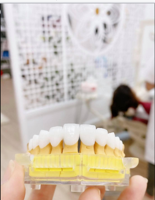 Là những chiếc răng xinh mà khách hàng đã tin tưởng không ngần ngại khoảng cách địa lý và thời thế đến với Dr Bảo Hưng thay đổi nụ cười