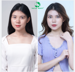 Làm đẹp an toàn, không đau, không sẹo với phương pháp cắt mí hiện đại TOP 1 cùng bác sĩ tay nghề chuyên môn cao tại Thu Cúc