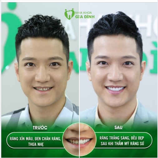 LÀM RĂNG HÔM NAY-NHẬN NGAY ƯU ĐÃI