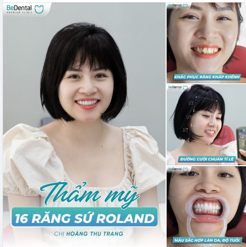 "Làm răng xong ai cũng khen trẻ ra và xinh hơn lên bao nhiêu chân kính" - Chị Trang sau quyết định làm 16 răng sứ Roland tại nha khoa BeDental