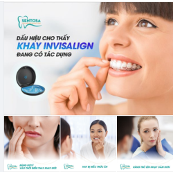 LÀM SAO ĐỂ BIẾT KHAY INVISALIGN ĐANG CÓ TÁC DỤNG