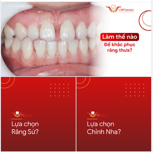 LÀM THẾ NÀO ĐỂ KHẮC PHỤC KHUYẾT ĐIỂM RĂNG THƯA