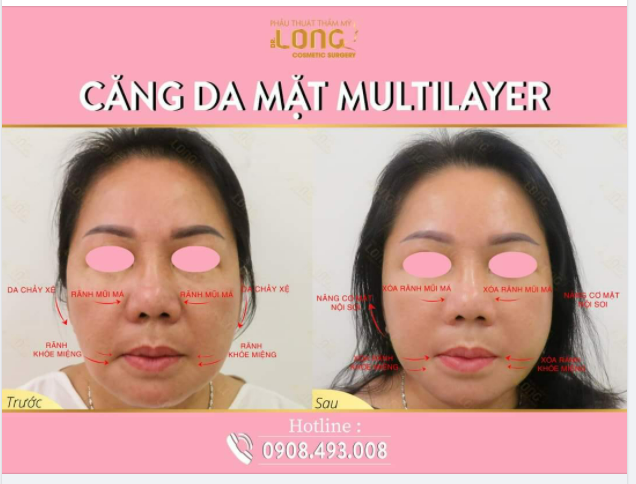 LÀN DA 0 TUỔI THÁCH THỨC MỌI THỜI GIAN