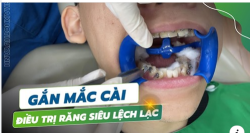 LẬP KẾ HOẠCH ĐIỀU TRỊ NIỀNG RĂNG CHO TRƯỜNG HỢP RĂNG SIÊU LỆCH LẠC
