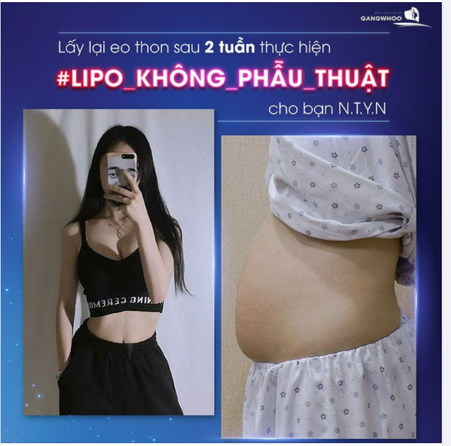 LẤY LẠI EO THON SAU 2 TUẦN THỰC HIỆN LIPO HÚT MỠ KHÔNG PHẪU THUẬT CHO BẠN N.T.Y.N