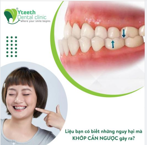 LIỆU BẠN ĐÃ BIẾT NHỮNG NGUY HẠI MÀ TÌNH TRẠNG KHỚP CẮN NGƯỢC GÂY RA