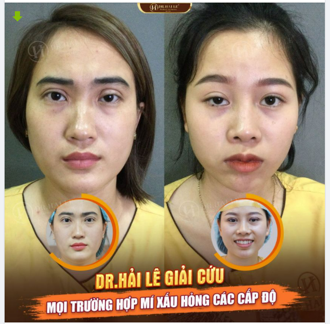 “Lỡ” thích nếp mí quá to thì phải xem ngay bài viết này!