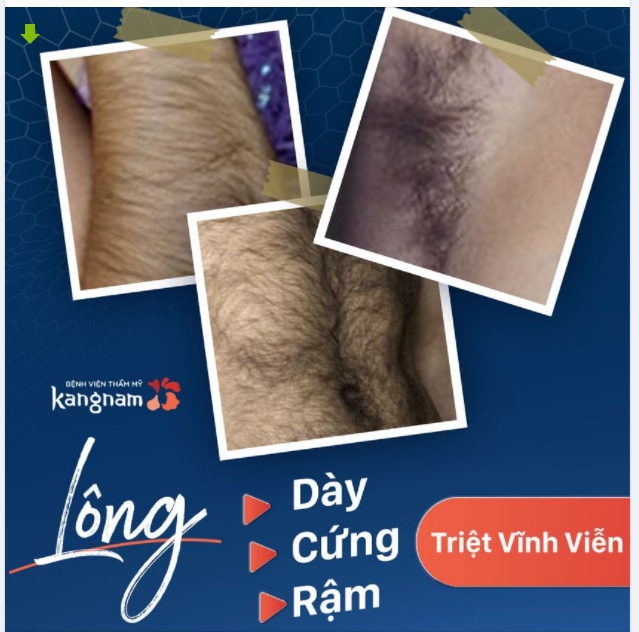 Lông Đen - Rậm - Cứng có triệt được hết không?