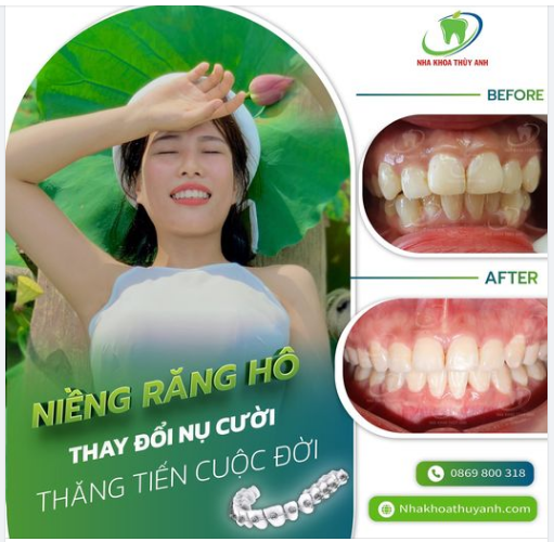 LỘT XÁC NHỜ NIỀNG RĂNG HÔ, TỰ TIN SELFIE KHÔNG GÓC CHẾT