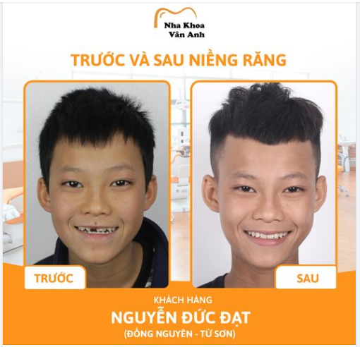 “LỘT XÁC” NỤ CƯỜI SAU NIỀNG RĂNG TẠI NHA KHOA VÂN ANH