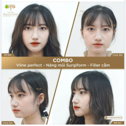 Lột xác- ĐẸP TOÀN DIỆN sau khi làm Combo: Thon gọn mặt Vline Perfect- Nâng mũi Surgiform- Filler Cằm.