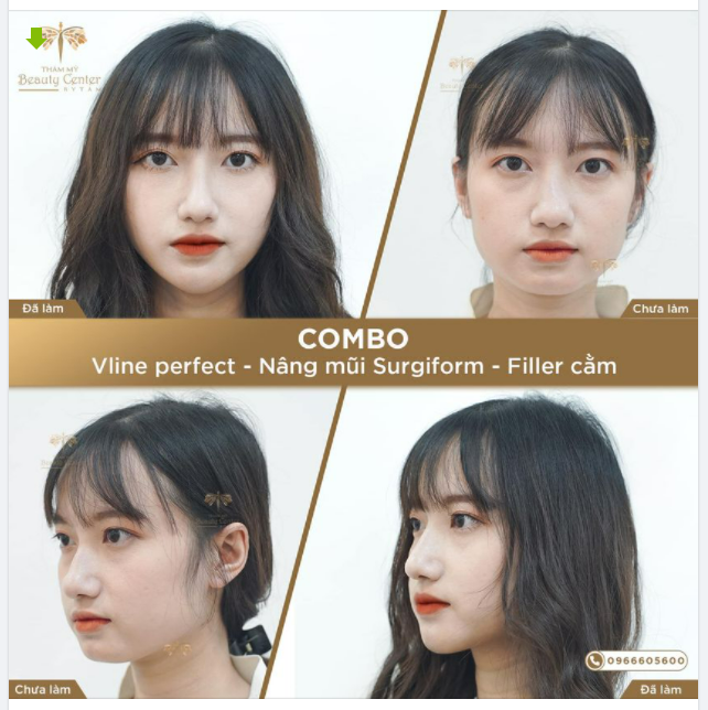 Lột xác- ĐẸP TOÀN DIỆN sau khi làm Combo: Thon gọn mặt Vline Perfect- Nâng mũi Surgiform- Filler Cằm.