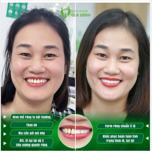 LỰA CHỌN LÀM RĂNG – CƯỜI XINH TỎA NẮNG