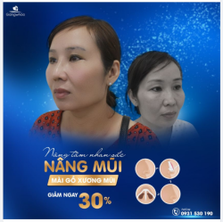 MÀI GỒ XƯƠNG MŨI – NÂNG TẦM NHAN SẮC