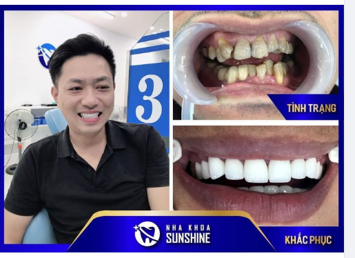 MANG LẠI NỤ CƯỜI VIÊN MÃN CHO ANH KHÁCH HÀNG TẠI NHA KHOA THẨM MỸ SUNSHINE