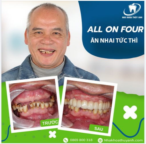 MANG LẠI SỰ TỰ TIN - ĂN NHAI NGAY TỨC THÌ VỚI HÀM ALL ON 4