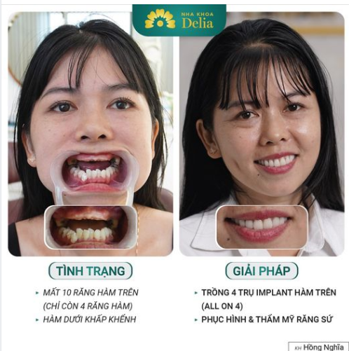 MẤT 10 RĂNG CHỈ CẦN TRỒNG 4 CHÂN RĂNG