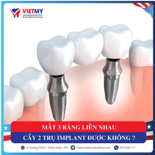 Mất 3 răng liền nhau cấy 2 trụ Implant được không 
