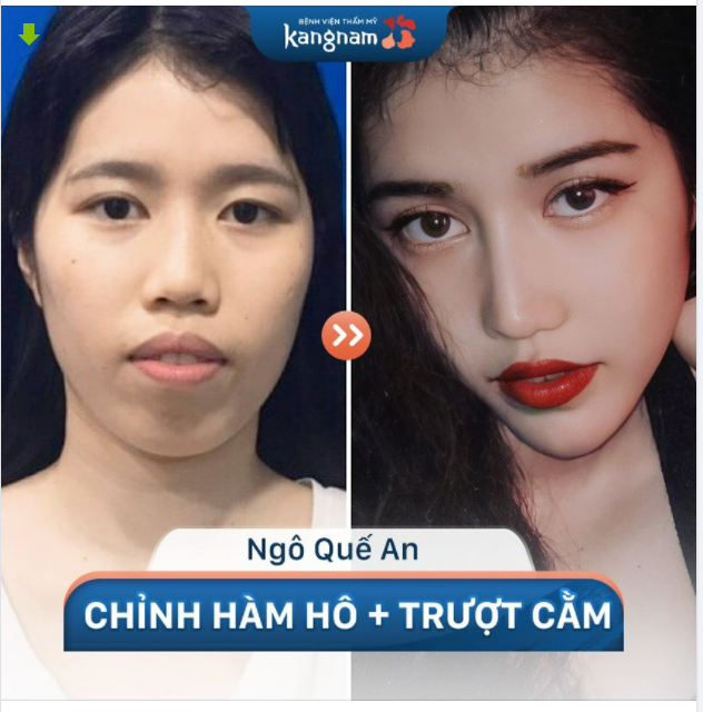 Măt góc cạnh, hàm hô hóa nhỏ gọn Vline