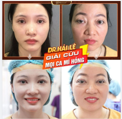 Mắt lỗi hỏng: Lệch to nhỏ, mí size quá to, đính sâu, khuyết mỡ, sụp mi, cường cơ gây trợn, sẹo co dính... Bạn thuộc trường hợp nào?