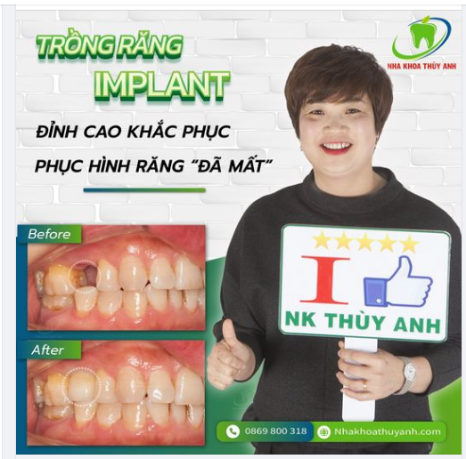 MẤT RĂNG CỬA, TRỒNG LẠI RĂNG IMPLANT NHƯ THẾ NÀO?