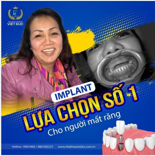 MẤT RĂNG HÃY CHỌN TRỒNG RĂNG IMPLANT