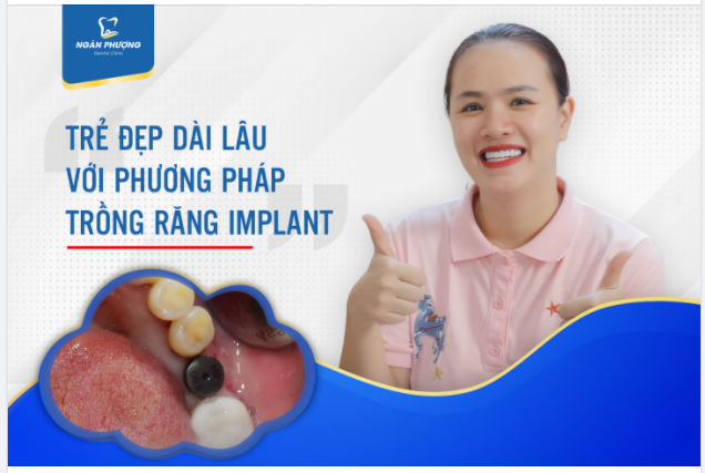 Mất răng không chỉ mang theo nỗi lo về chức năng ăn nhai, khó khăn trong sinh hoạt mà cả những nguy cơ mất thẩm mỹ và đặc biệt để lâu sẽ dẫn đến tiêu xương hàm.