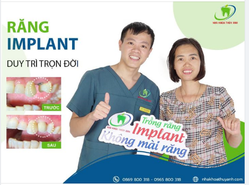 MẤT RĂNG KHÔNG TRỒNG NGAY RĂNG IMPLANT CÒN CHỜ TỚI BAO GIỜ