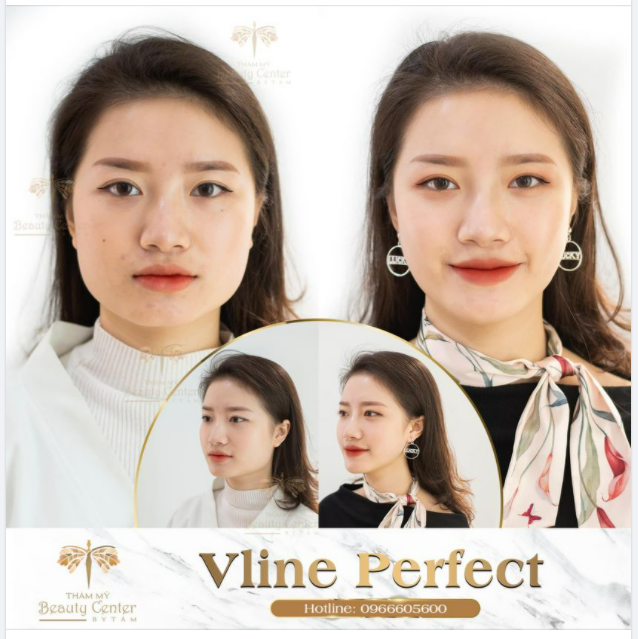 MẶT TO MẤY CŨNG PHẢI NHỎ LẠI VỚI VLINE PEFECT