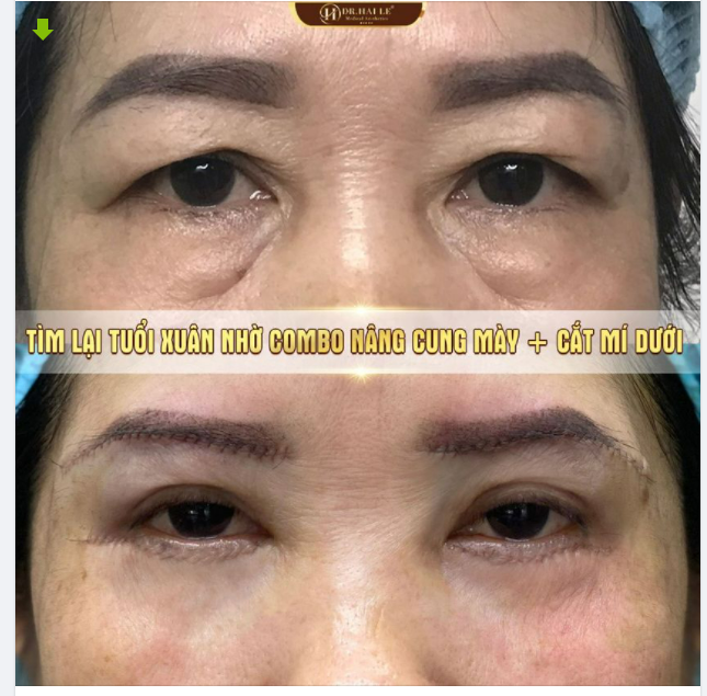 Mẹ muốn đôi mắt trẻ hơn chút, mắt mẹ sụp mí quá, nhiều bọng mỡ mắt quá!