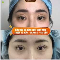 Mí bị hỏng do cắt chưa đúng kỹ thuật tại các cơ sở không uy tín, hoàn toàn có thể SỬA LẠI và cải thiện lên tới 90% ngay trong khoảng thời gian trước 12 ngày.