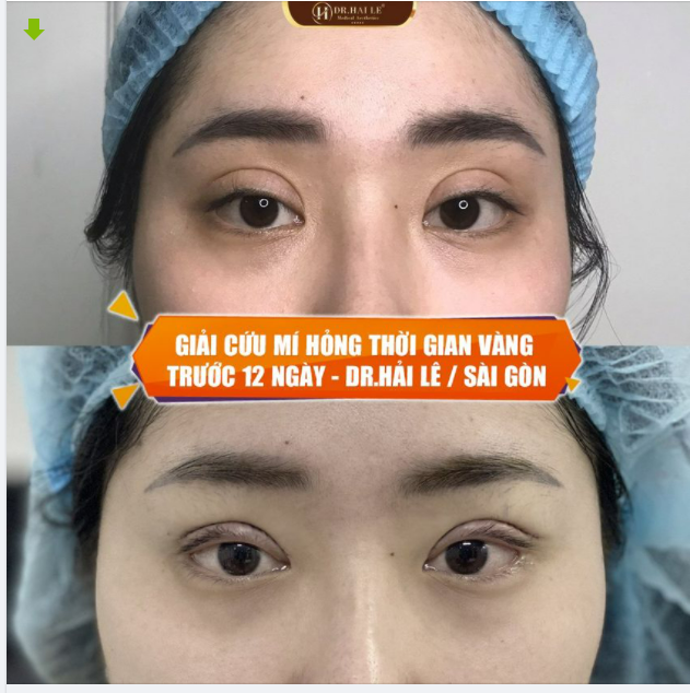 Mí bị hỏng do cắt chưa đúng kỹ thuật tại các cơ sở không uy tín, hoàn toàn có thể SỬA LẠI và cải thiện lên tới 90% ngay trong khoảng thời gian trước 12 ngày.