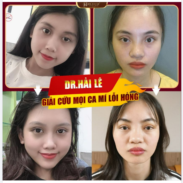 Mí KHÓ - MÍ CẮT HỎNG ​​​​​​​ SỬA NGAY CÒN KỊP