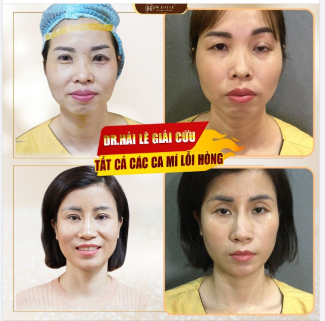 Mí lỗi không chỉ xấu về thẩm mĩ, mà còn dẫn đến những hệ lụy nguy hiểm cho sức khỏe, thậm chí mù lòa. Tuy nhiên bạn đừng quá lo lắng vì mí lỗi hoàn toàn có thể sửa được.