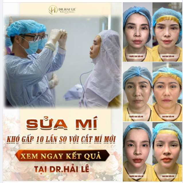 MÍ XẤU HỎNG TỚI ĐÂU - Dr.Hải Lê đều xử lý được với kỹ thuật SỬA MÍ DEEP TECH.!!