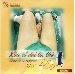 Mỡ đùi nhiều làm cho đùi trở nên quá thô và to bè vừa gây ảnh hưởng tới yếu tố thẩm mỹ, vừa khiến chị em mất tự tin không dám diện những bộ váy ngắn, quần short.