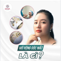 MỞ RỘNG GÓC MẮT LÀ GÌ - TRƯỜNG HỢP NÀO NÊN MỞ RỘNG GÓC MẮT ?