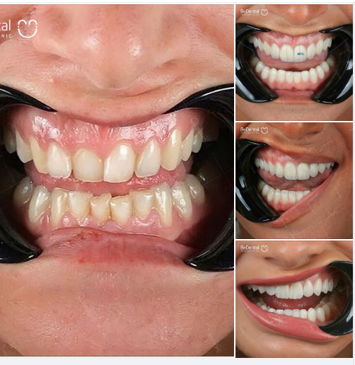 Mỗi chiếc răng sứ mà BeDental thực hiện từ khâu thăm khám đánh giá tình trạng đến đo vẽ, chế tác và lắp hoàn thiện đều được tính toán tỉ mỉ, chuẩn xác từng milimet