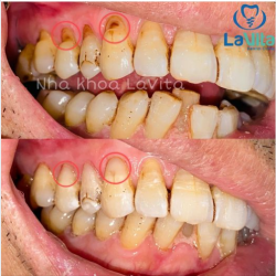 MÒN CỔ RĂNG LÀ GÌ? CÓ NGUY HIỂM KHÔNG?