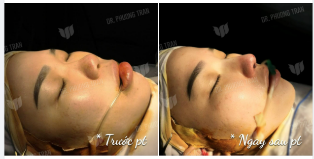 MỘT CHIẾC MŨI NGẮN THAY ĐỔI NGOẠN MỤC SAU 60 PHÚT NÂNG MŨI CẤU