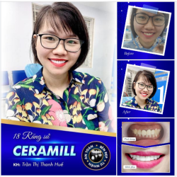 Một chút feedback chân thực của chị Thanh Huế sau khi thực hiện bọc 18 răng sứ Ceramill