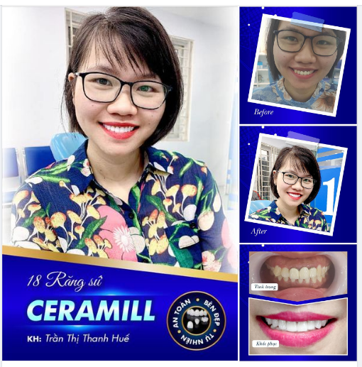 Một chút feedback chân thực của chị Thanh Huế sau khi thực hiện bọc 18 răng sứ Ceramill